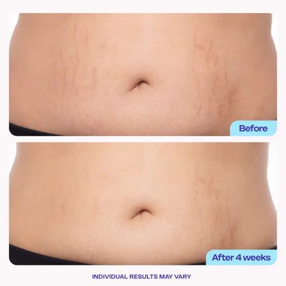 DermaTight™ | Belly Firming & Stretch Mark Cream – Smooth, Tighten & Restore Confidence