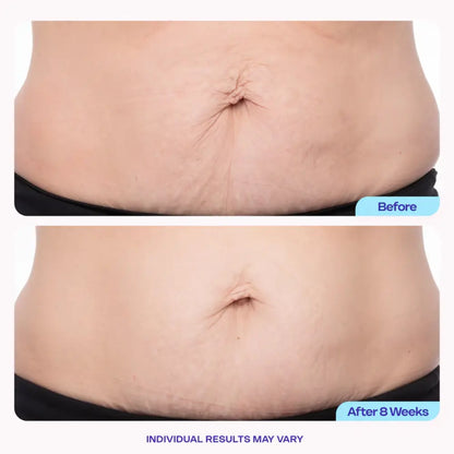 DermaTight™ | Belly Firming & Stretch Mark Cream – Smooth, Tighten & Restore Confidence