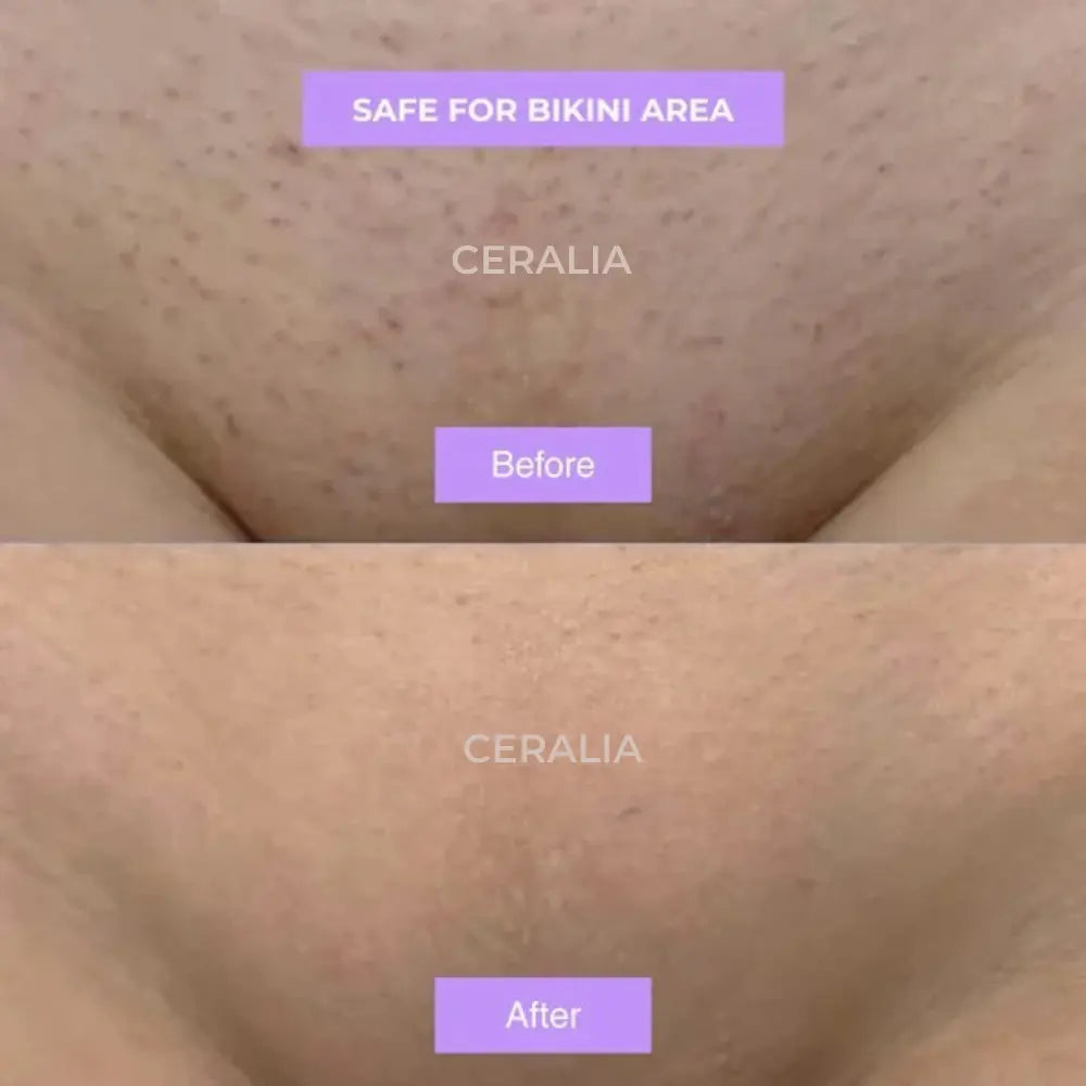 Ceralia™ | Cyperus Rotundus Hair Growth Reduction Serum