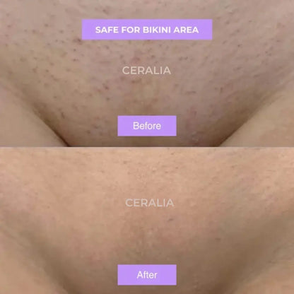 Ceralia™ | Cyperus Rotundus Hair Growth Reduction Serum