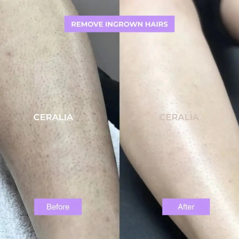 Ceralia™ | Cyperus Rotundus Hair Growth Reduction Serum